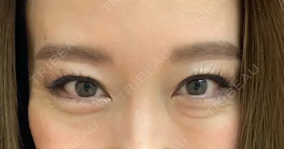 クマ治療 / 下まぶたたるみ取り / 下まぶたの脂肪取り セオリークリニック DAY 155 メイン用