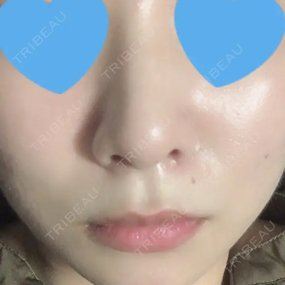 鼻尖形成（切開） / 小鼻縮小（切開） 湘南美容クリニック 神戸院 AFTER メイン用