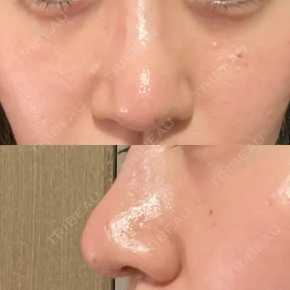 鼻尖形成（切開） / 鼻尖縮小 / その他（鼻） 聖心美容クリニック 札幌院 DAY 12 メイン用