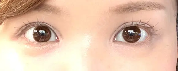 二重切開 / 目頭切開 EMMA CLINIC（エマクリニック） AFTER メイン用