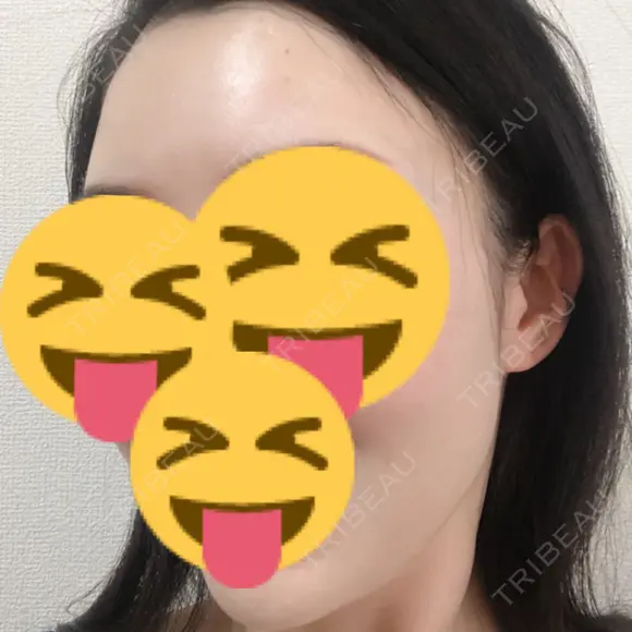 脂肪注入（額） 牧野美容クリニック DAY 30 メイン用