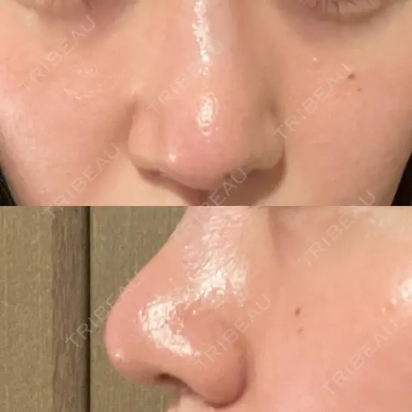 鼻尖形成（切開） / 鼻尖縮小 / その他（鼻） 聖心美容クリニック 札幌院 DAY 13 メイン用