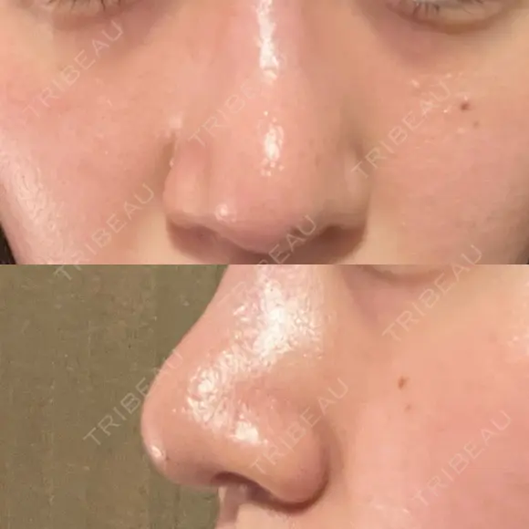 鼻尖形成（切開） / 鼻尖縮小 / その他（鼻） 聖心美容クリニック 札幌院 DAY 14 メイン用