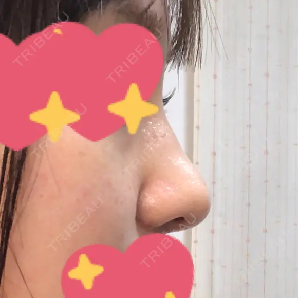 鼻尖形成（切開） / 小鼻縮小（切開） / その他（鼻） / 軟骨移植 グローバルビューティークリニック 東京院 DAY 10 メイン用