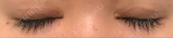 二重切開 松下皮フ形成外科 DAY 15 メイン用