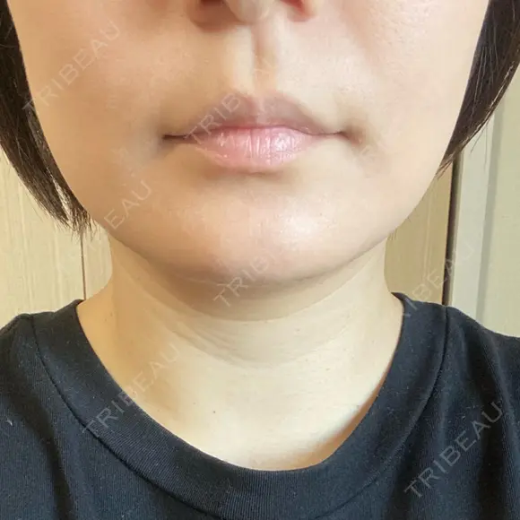 脂肪吸引（顔） THE CLINIC（ザ・クリニック） 福岡院 DAY 14 メイン用