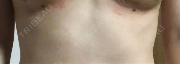 脂肪吸引（お腹） / 脂肪吸引（お尻） / 豊胸（脂肪注入） / その他（ボディ） ドクターフィット（Dr.fit）クリニック DAY 12 メイン用