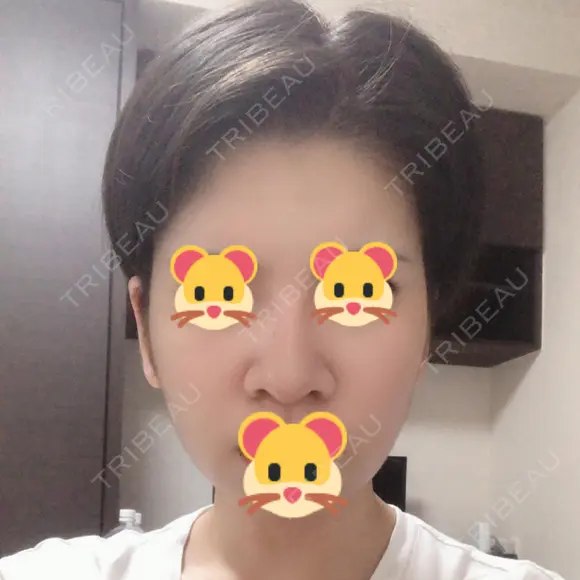 隆鼻術 / 鼻尖形成（切開） / 鼻中隔延長（切開） / 骨切幅寄せ 表参道スキンクリニック 表参道院 DAY 223 メイン用