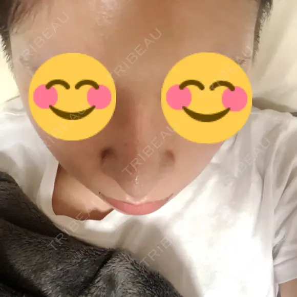 隆鼻術 / 鼻尖形成（切開） / 鼻中隔延長（切開） / 骨切幅寄せ 表参道スキンクリニック 表参道院 DAY 223 メイン用