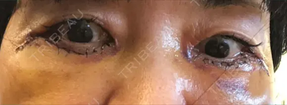 下まぶたたるみ取り / 下まぶたの脂肪取り / 美容点滴・美容注射（美肌） / 白玉点滴・注射 キップン整形外科 DAY 3 メイン用