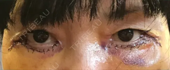 下まぶたたるみ取り / 下まぶたの脂肪取り / 美容点滴・美容注射（美肌） / 白玉点滴・注射 キップン整形外科 DAY 3 メイン用