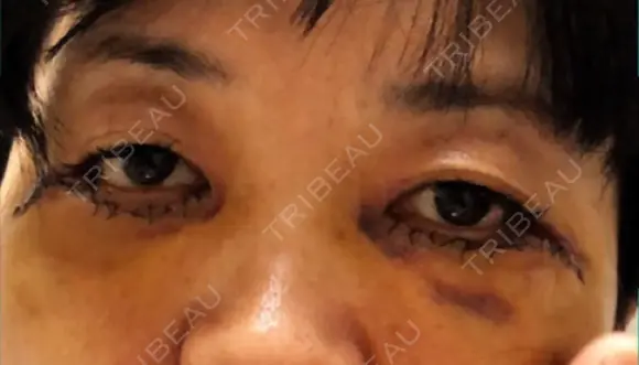 下まぶたたるみ取り / 下まぶたの脂肪取り / 美容点滴・美容注射（美肌） / 白玉点滴・注射 キップン整形外科 DAY 5 メイン用