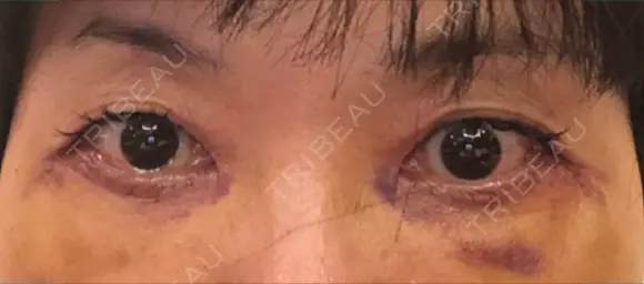 下まぶたたるみ取り / 下まぶたの脂肪取り / 美容点滴・美容注射（美肌） / 白玉点滴・注射 キップン整形外科 DAY 6 メイン用