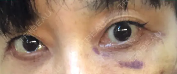 下まぶたたるみ取り / 下まぶたの脂肪取り / 美容点滴・美容注射（美肌） / 白玉点滴・注射 キップン整形外科 DAY 10 メイン用