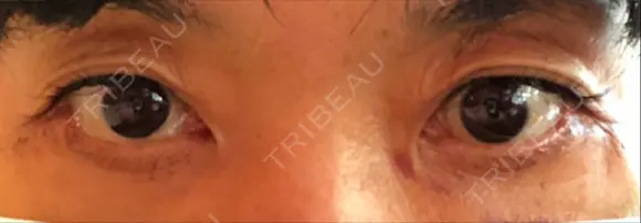 下まぶたたるみ取り / 下まぶたの脂肪取り / 美容点滴・美容注射（美肌） / 白玉点滴・注射 キップン整形外科 AFTER メイン用