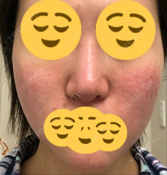 ほくろ・いぼ切除（肌） / その他（肌） / 美肌レーザー / シミ取りレーザー / 美白レーザー クロスクリニック銀座 DAY 42 メイン用