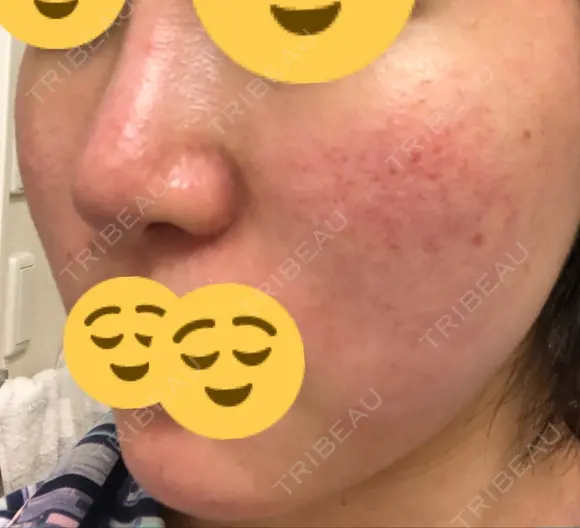 ほくろ・いぼ切除（肌） / その他（肌） / 美肌レーザー / シミ取りレーザー / 美白レーザー クロスクリニック銀座 DAY 42 メイン用