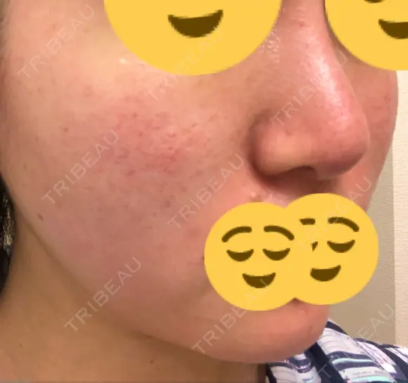 ほくろ・いぼ切除（肌） / その他（肌） / 美肌レーザー / シミ取りレーザー / 美白レーザー クロスクリニック銀座 DAY 42 メイン用