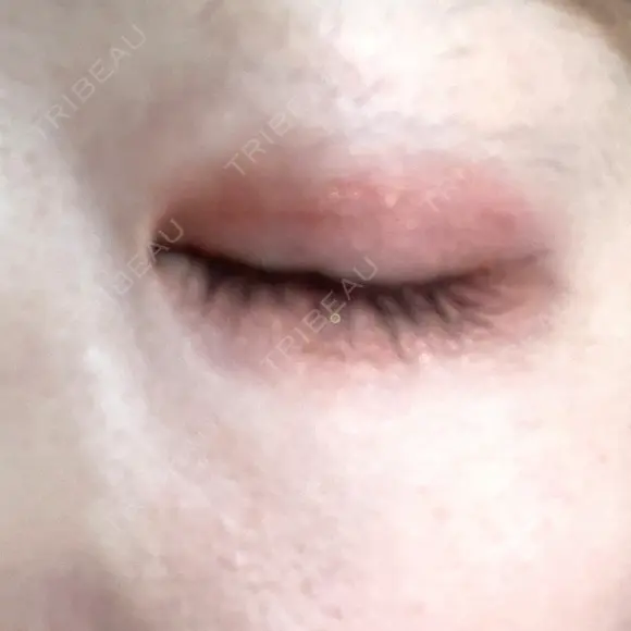 二重埋没 AiZ CLINIC DAY 60 メイン用