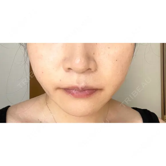 バッカルファット除去 / 脂肪吸引（顔） EMMA CLINIC（エマクリニック） DAY 11 メイン用