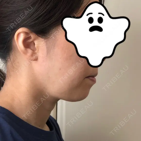 ハイフ（顔） 藤・ナチュレ美容クリニック 恵比寿院 DAY 31 メイン用