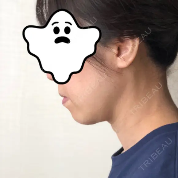 ハイフ（顔） 藤・ナチュレ美容クリニック 恵比寿院 DAY 31 メイン用