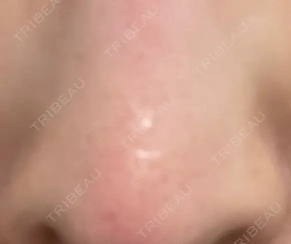 フラクショナルレーザー（毛穴・ニキビ跡） PICO BEAUTY CLINIC AFTER メイン用