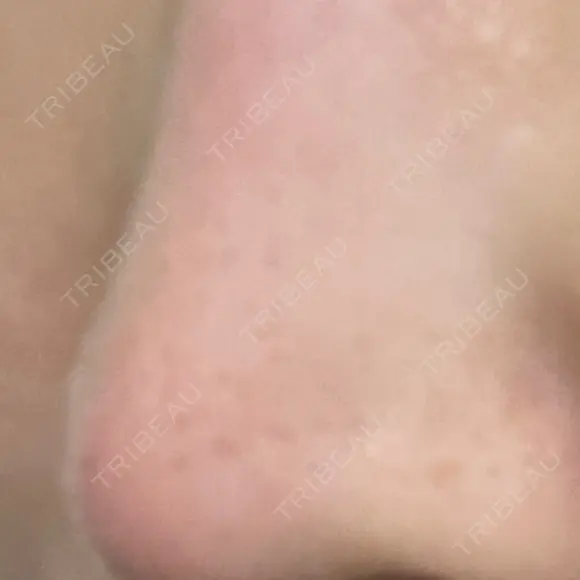 フラクショナルレーザー（毛穴・ニキビ跡） PICO BEAUTY CLINIC DAY 23 メイン用
