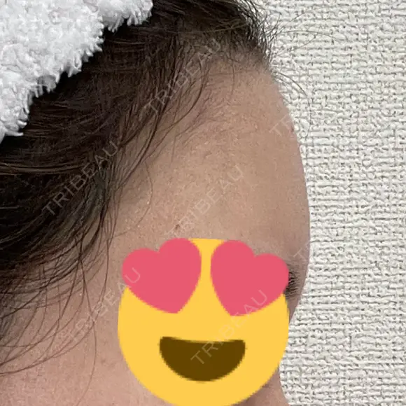 脂肪注入（額） / 脂肪注入（輪郭） 牧野美容クリニック DAY 16 メイン用