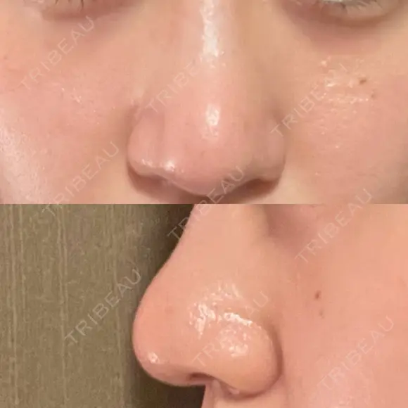 鼻尖形成（切開） / 鼻尖縮小 / その他（鼻） 聖心美容クリニック 札幌院 DAY 20 メイン用