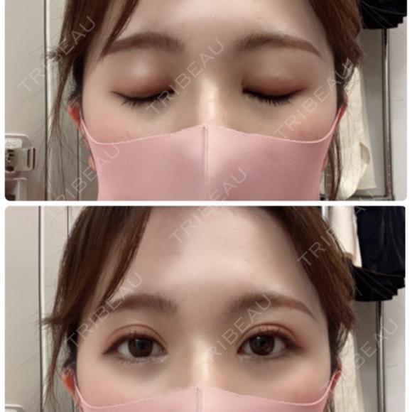 二重埋没 湘南美容クリニック 渋谷院 AFTER メイン用