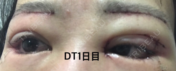 二重切開 / 目頭切開 / 眼瞼下垂（切開） / 目尻切開 / 眉下切開 / その他 A CLINIC（エークリニック） 横浜院 DAY 0 メイン用