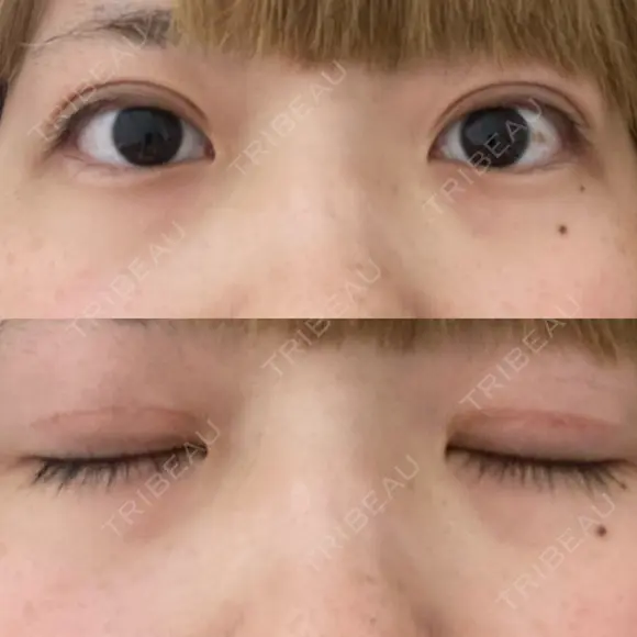 二重切開 松下皮フ形成外科 DAY 25 メイン用