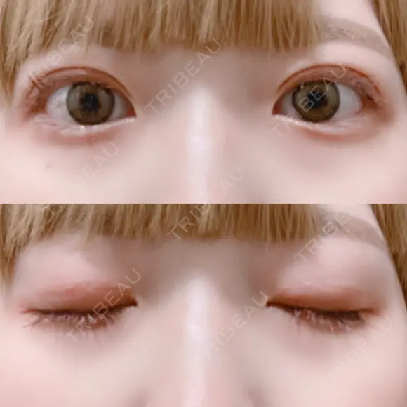 二重切開 松下皮フ形成外科 DAY 27 メイン用