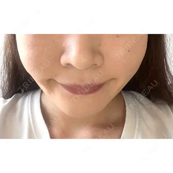 バッカルファット除去 / 脂肪吸引（顔） EMMA CLINIC（エマクリニック） DAY 18 メイン用