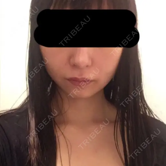 脂肪吸引（顔） / その他（輪郭） / 脂肪注入（輪郭） ヴィヴェンシアクリニック DAY 47 メイン用
