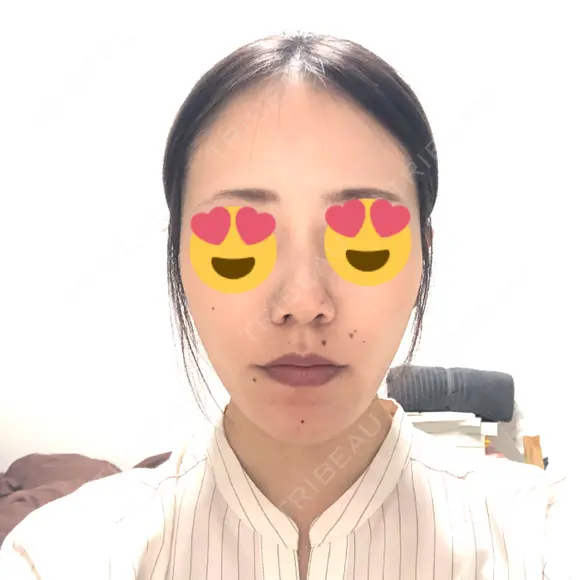 骨切り（あご） / 脂肪吸引（顔） 銀座マイアミ美容外科 DAY 129 メイン用