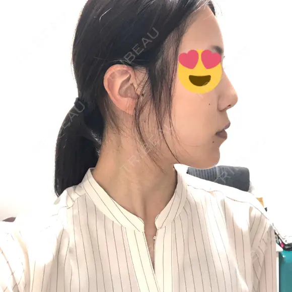 骨切り（あご） / 脂肪吸引（顔） 銀座マイアミ美容外科 DAY 129 メイン用