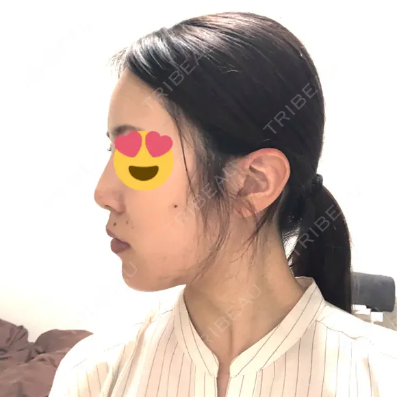 骨切り（あご） / 脂肪吸引（顔） 銀座マイアミ美容外科 DAY 129 メイン用