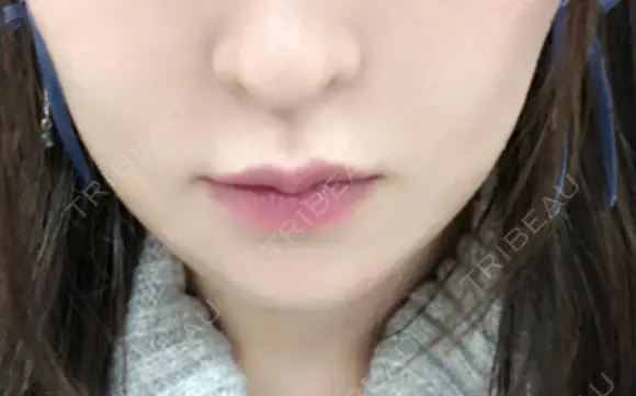 骨切り（あご） / 輪郭修正 / ボトックス（エラ・小顔） 心斎橋コムロ美容外科クリニック DAY 74 メイン用