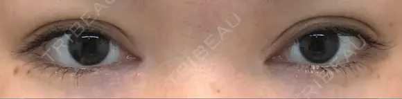 二重切開 松下皮フ形成外科 DAY 27 メイン用