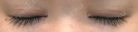 二重切開 松下皮フ形成外科 DAY 27 メイン用