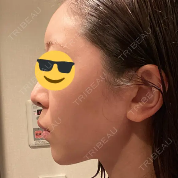 糸リフト / 脂肪吸引（顔） / ボトックス（あご） WOM CLINIC GINZA （ワム クリニック ギンザ） DAY 244 メイン用