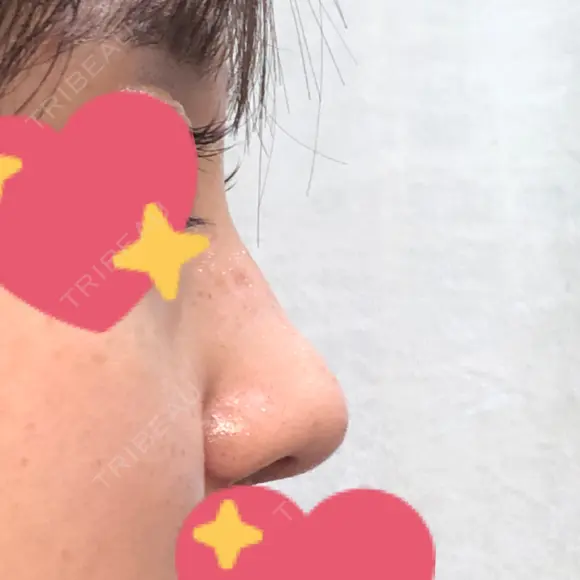 鼻尖形成（切開） / 小鼻縮小（切開） / その他（鼻） / 軟骨移植 グローバルビューティークリニック 東京院 DAY 24 メイン用