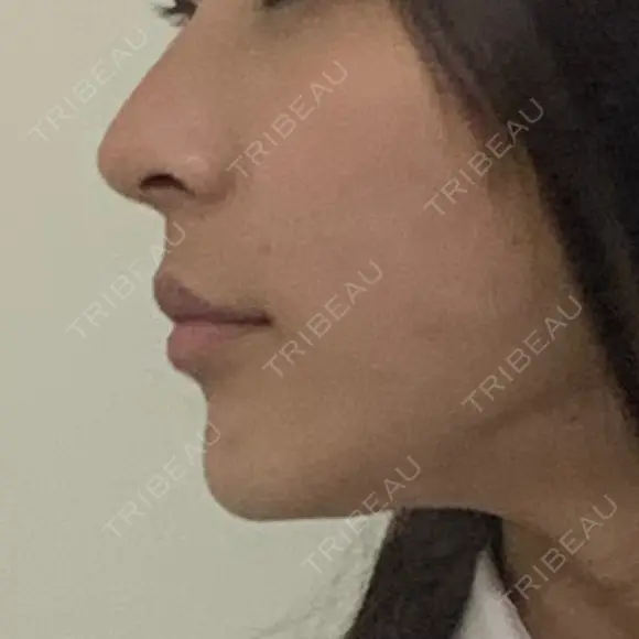 糸リフト / 骨切り（あご） / 脂肪吸引（顔） / ボトックス（エラ・小顔） 銀座マイアミ美容外科 DAY 161 メイン用