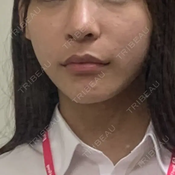 糸リフト / 骨切り（あご） / 脂肪吸引（顔） / ボトックス（エラ・小顔） 銀座マイアミ美容外科 DAY 161 メイン用