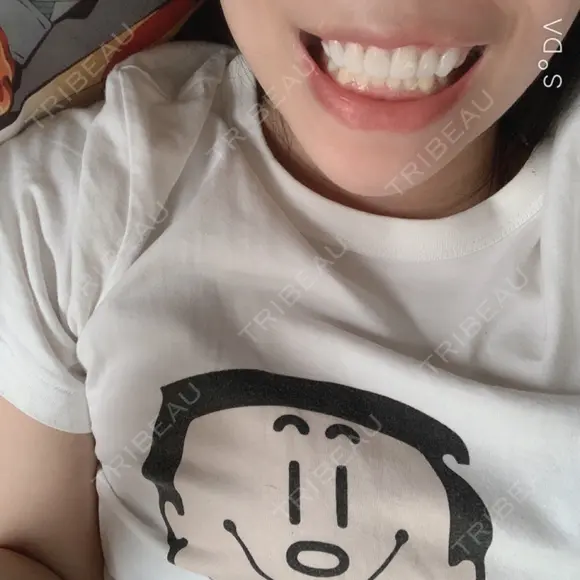 ガミースマイル手術 / 矯正（ワイヤー） / セラミック / ホワイトニング ラ・ブージュデンタルクリニック AFTER メイン用