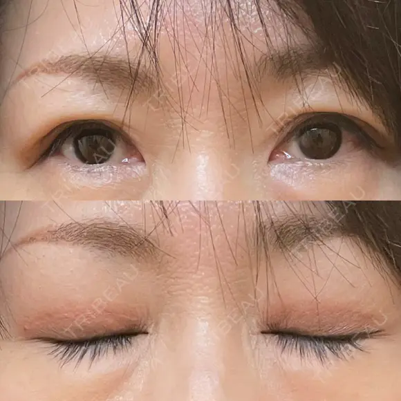 二重切開 / 上まぶたたるみ取り / 上まぶたの脂肪取り 松下皮フ形成外科 AFTER メイン用