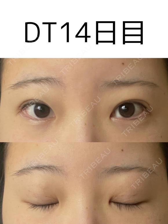 二重埋没 けやき美容クリニック 沼津院 DAY 14 メイン用