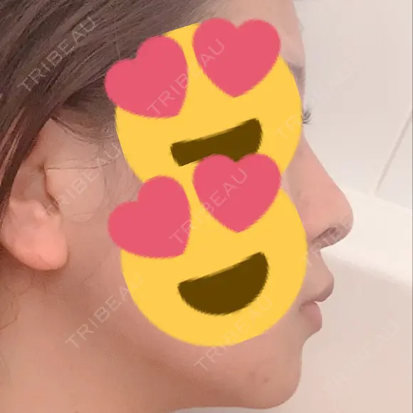 隆鼻術 / 鼻中隔延長（切開） / 眉間プロテーゼ プリモ麻布十番クリニック DAY 74 メイン用